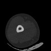 SPORK, NICO - 22.03.1976 - 02.08.2022 - CT obere Extremität - 17:51:17